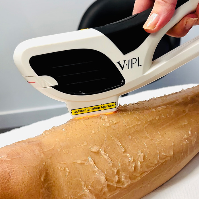 JAMBES ENTIÈRES - IPL - EPILATION LUMIERE PULSEE